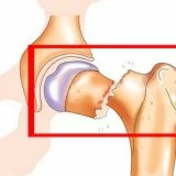 Последствия перелома шейки бедра в молодом возрасте: риски и осложнения, методы лечения и реабилитации