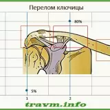 Диагноз – перелом ключицы код по МКБ 10 (S42): виды, причины, симптомы, лечение