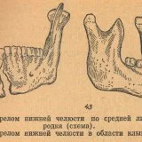 Признаки перелома челюсти, виды травм, причины, диагностика, первая помощь и лечение