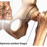 Как распознать патологию и что делать при переломе шейки бедра, проверенные методы реабилитации