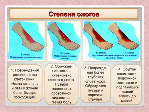 Степени повреждения при ожогах и обморожениях имеют сходные характеристики.