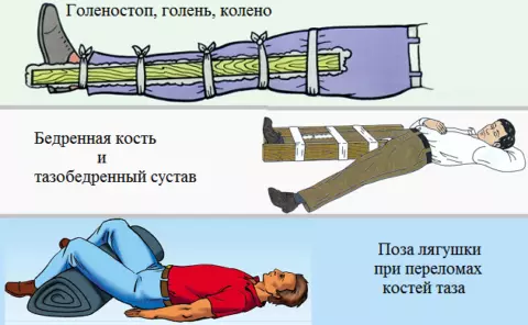 Иммобилизация сломанной ноги или таза.