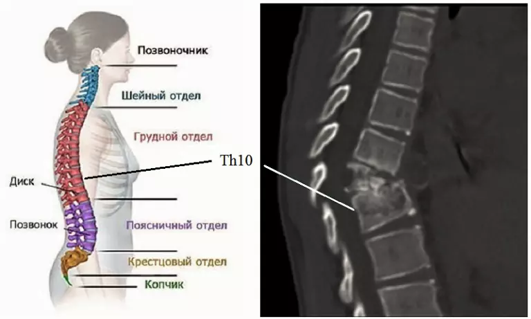 9 10 позвонки. Компрессионный перелом позвоночника th5. Позвоночника th5-th12. Компрессионный перелом позвоночника th11-l1. Th3 th10 позвонка.